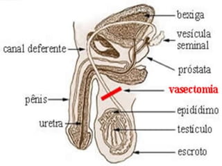    A vasectomia é o nome dado ao
    processo de esterilização masculina,
    feito cirurgicamente.
   Ele seria, grosso modo, a versão
    masculina da ligadura de trompas,
    também chamada de laqueadura.
   Para entender melhor sobre tal assunto
    é necessário recordar alguns aspectos
    relacionados ao sistema genital
    masculino:
 