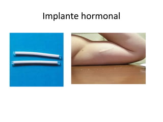 Implante hormonal
 