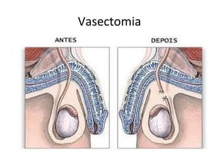 Vasectomia
 