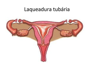 Laqueadura tubária
 