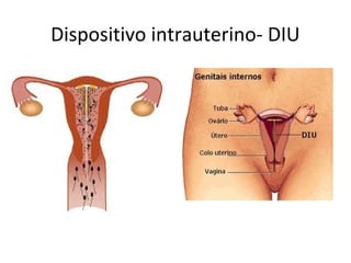 Dispositivo intrauterino- DIU
 