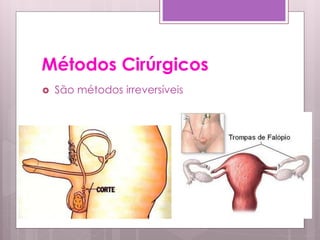Métodos Cirúrgicos
   São métodos irreversíveis
 