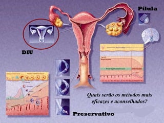 DIU
Preservativo
Pílula
Quais serão os métodos mais
eficazes e aconselhados?
 