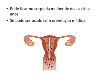 • Pode ficar no corpo da mulher de dois a cinco
anos
• Só pode ser usado com orientação médica
 