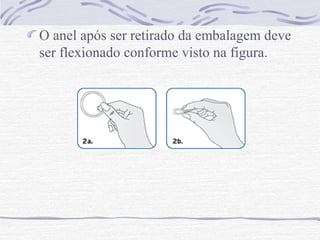 O anel após ser retirado da embalagem deve
ser flexionado conforme visto na figura.
 