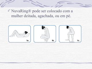 NuvaRing® pode ser colocado com a
mulher deitada, agachada, ou em pé.
 