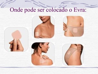 Onde pode ser colocado o Evra:
 