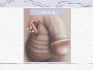 VASECTOMIA
 