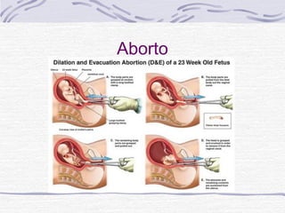 Aborto
 