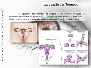 M
É
T
O
D
O
S
C
I
R
Ú
R
G
I
C
O
S
Laqueação das Trompas
A laqueação das trompas de Falópio é um método cirúrgico e
definitivo, realizado na mulher, com o corte ou ligamento destas. Deste modo,
não é possível o encontro dos gâmetas masculinos e femininos nas trompas.
 