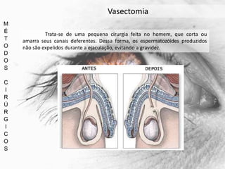 M
É
T
O
D
O
S
C
I
R
Ú
R
G
I
C
O
S
Vasectomia
Trata-se de uma pequena cirurgia feita no homem, que corta ou
amarra seus canais deferentes. Dessa forma, os espermatozóides produzidos
não são expelidos durante a ejaculação, evitando a gravidez.
 