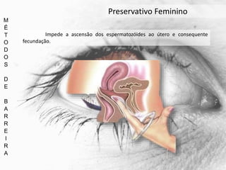 M
É
T
O
D
O
S
D
E
B
A
R
R
E
I
R
A
Preservativo Feminino
Impede a ascensão dos espermatozóides ao útero e consequente
fecundação.
 