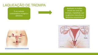 LAQUEAÇÃO DE TROMPA
É um método
contraceptivo cirúrgico e
definitivo
Realizado na mulher,
através de corte das
trompas, impedindo, que
os gâmetas masculinos e
femininos encontrem-se
 