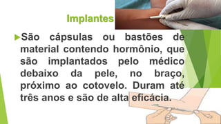 Implantes
São cápsulas ou bastões de
material contendo hormônio, que
são implantados pelo médico
debaixo da pele, no braço,
próximo ao cotovelo. Duram até
três anos e são de alta eficácia.
 
