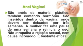 Anel Vaginal
São anéis de material plástico,
também contendo hormônio. São
inseridos dentro da vagina, onde
devem ser deixados por três
semanas. A mulher faz uma pausa
de uma semana e reinicia o uso.
Não atrapalha a relação sexual, nem
causa incômodo. É bastante eficaz.
 