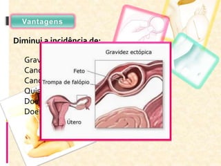 Diminui a incidência de:
Gravidez ectópica;
Cancro no endométrio;
Cancro nos ovários;
Quistos nos ovários;
Doenças inflamatórias pélvicas (DIP);
Doenças mamárias benignas;
 