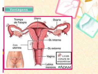 Duração e eficácia muito alta;
Não tem os efeitos secundários dos
estrogénios;
Como é colocado pela via subdérmica não
apresenta efeitos secundários no fígado
(Implanon);
Melhora e previne muitas doenças, como a
endometriose, eritropoiese ou mesmo
anemia de células falciformes.
 