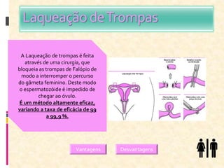 Laqueação deTrompas
A Laqueação de trompas é feita
através de uma cirurgia, que
bloqueia as trompas de Falópio de
modo a interromper o percurso
do gâmeta feminino. Deste modo
o espermatozóide é impedido de
chegar ao óvulo.
É um método altamente eficaz,
variando a taxa de eficácia de 99
a 99,9 %.
Vantagens Desvantagens
 