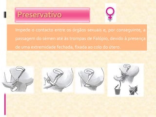 Preservativo
Impede o contacto entre os órgãos sexuais e, por conseguinte, a
passagem do sémen até às trompas de Falópio, devido à presença
de uma extremidade fechada, fixada ao colo do útero.
 