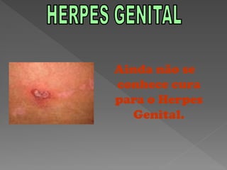 Ainda não se
conhece cura
para o Herpes
   Genital.
 