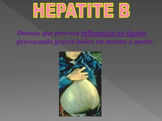 Doença que provoca inflamação no fígado,
provocando graves lesões ou mesmo a morte.
 