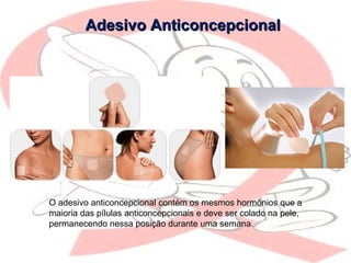 Adesivo AnticoncepcionalAdesivo Anticoncepcional
O adesivo anticoncepcional contém os mesmos hormônios que a
maioria das pílulas anticoncepcionais e deve ser colado na pele,
permanecendo nessa posição durante uma semana.
 