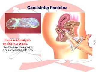 Camisinha femininaCamisinha feminina
. Evita a aquisição
de DSTs e AIDS.
. A eficácia contra a gravidez
é de aproximadamente 97%.
 