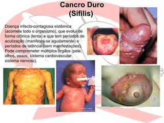 Cancro DuroCancro Duro
(Sífilis)(Sífilis)
Doença infecto-contagiosa sistêmica
(acomete todo o organismo), que evolui de
forma crônica (lenta) e que tem períodos de
acutização (manifesta-se agudamente) e
períodos de latência (sem manifestações).
Pode comprometer múltiplos órgãos (pele,
olhos, ossos, sistema cardiovascular,
sistema nervoso).
 