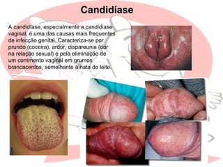 CandidíaseCandidíase
A candidíase, especialmente a candidíase
vaginal, é uma das causas mais frequentes
de infecção genital. Caracteriza-se por
prurido (coceira), ardor, dispareunia (dor
na relação sexual) e pela eliminação de
um corrimento vaginal em grumos
brancacentos, semelhante à nata do leite.
 