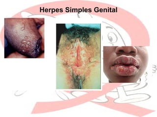 Herpes Simples Genital
 