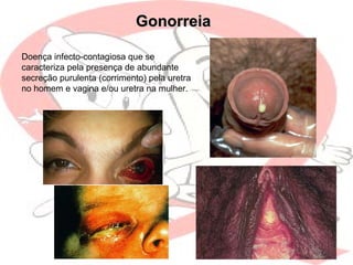 GonorreiaGonorreia
Doença infecto-contagiosa que se
caracteriza pela presença de abundante
secreção purulenta (corrimento) pela uretra
no homem e vagina e/ou uretra na mulher.
 