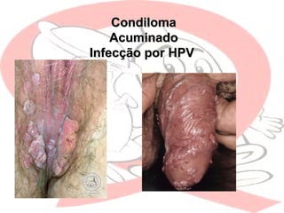 CondilomaCondiloma
AcuminadoAcuminado
Infecção por HPVInfecção por HPV
 