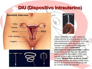 DIU (Dispositivo Intrauterino)DIU (Dispositivo Intrauterino)
. Ele é implantado na região uterina da
mulher através de uma pequena cirurgia,
mais precisamente no diafragma. A cirurgia
para implantação dura alguns poucos
minutos e só precisa de anestesia local.
. Ele faz com que o endométrio
interrompa os espermatozoides, evitando
dessa forma que ele fecunde. Se mesmo
assim o óvulo for fecundado, o DIU evita
que ele se fixe e gere uma gravidez.
. A maior eficácia dele vai até os 4 anos.
Após esse período ele ainda protege cerca
de 97% as mulheres de ovularem em até
os 10 anos depois de colocado.
 