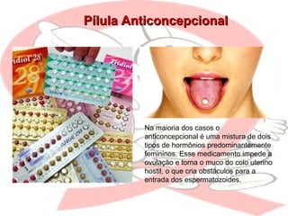 Pílula AnticoncepcionalPílula Anticoncepcional
Na maioria dos casos o
anticoncepcional é uma mistura de dois
tipos de hormônios predominantemente
femininos. Esse medicamento impede a
ovulação e torna o muco do colo uterino
hostil, o que cria obstáculos para a
entrada dos espermatozoides.
 