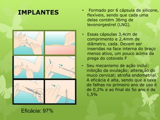 IMPLANTES
Eficácia: 97%
• Formado por 6 cápsula de silicone,
flexíveis, sendo que cada uma
delas contém 36mg de
levonorgestrel (LNG).
• Essas cápsulas 3,4cm de
comprimento e 2,4mm de
diâmetro, cada. Devem ser
inseridas na face interna do braço
menos ativo, um pouco acima da
prega do cotovelo F
• Seu mecanismo de ação inclui:
inibição da ovulação; alteração do
muco cervical; atrofia endometrial.
A eficácia é alta, sendo que a taxa
de falhas no primeiro ano de uso é
de 0,2% e ao final do 5o ano é de
1,5%
 