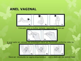 ANEL VAGINAL
 Colocado com a mulher deitada, agachada, ou em pé.
 O anel após ser retirado da embalagem deve ser flexionado conforme visto na
figura.
 Deve ser introduzido na vagina empurrando-o com o dedo até não senti-lo mais .
 