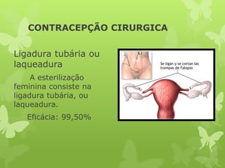 CONTRACEPÇÃO CIRURGICA
Ligadura tubária ou
laqueadura
A esterilização
feminina consiste na
ligadura tubária, ou
laqueadura.
Eficácia: 99,50%
 