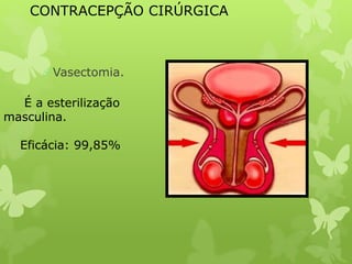 CONTRACEPÇÃO CIRÚRGICA
Vasectomia.
É a esterilização
masculina.
Eficácia: 99,85%
 