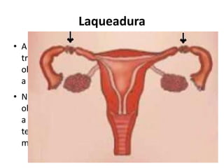 Laqueadura
• A laqueadura, também conhecida por ligadura de
  trompas, é um processo cirúrgico feito com
  objetivo contraceptivo, ou seja, que impede que
  a mulher engravide novamente.
• Nesse procedimento, as tubas uterinas são
  obstruídas, cortadas e/ou amarradas, impedindo
  a descida do óvulo e subida do espermatozóide,
  tendo como resultado um índice de concepção
  menor que 1%.
 