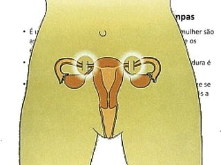 Laqueadura ou Ligação de Trompas
• É uma intervenção cirúrgica, onde as trompas da mulher são
  amarradas ou cortadas, evitando com que o óvulo e os
  espermatozóides se encontrem.
• É um método definitivo, ou seja, depois que a laqueadura é
  feita, é impossível engravidar novamente.
• Deve ser um método utilizado com muita certeza do que se
  está fazendo. Muitas mulheres se arrependem anos após a
  realização da esterilização, mesmo que tenham dito ter
  certeza do que queriam fazer.
• Só é indicado para mulheres maiores que 25 anos que já
  tenham pelo menos 2 filhos.
 