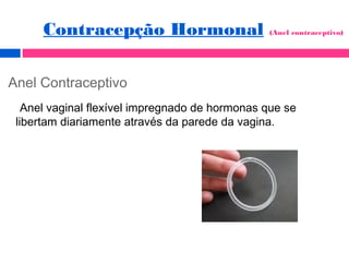 Anel Contraceptivo
Anel vaginal flexível impregnado de hormonas que se
libertam diariamente através da parede da vagina.
Contracepção Hormonal (Anel contraceptivo)
 