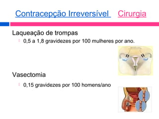 Laqueação de trompas
 0,5 a 1,8 gravidezes por 100 mulheres por ano.
Vasectomia
 0,15 gravidezes por 100 homens/ano
Contracepção Irreversível Cirurgia
 