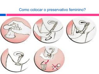 Como colocar o preservativo feminino?
 