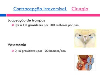 Laqueação de trompas 0,5 a 1,8 gravidezes por 100 mulheres por ano. Vasectomia 0,15 gravidezes por 100 homens/ano Contracepção Irreversível  Cirurgia 