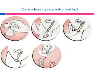 Como colocar o preservativo feminino? 