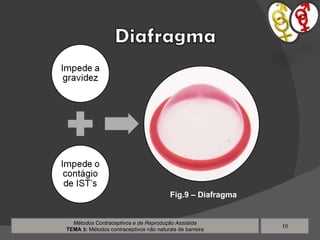 Métodos Contraceptivos e de Reprodução Assistida TEMA  3 :  Métodos contraceptivos não naturais de barreira Fig.9 – Diafragma 
