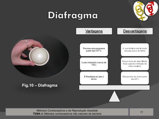 Métodos Contraceptivos e de Reprodução Assistida TEMA  3 :  Métodos contraceptivos não naturais de barreira Fig.10 – Diafragma 