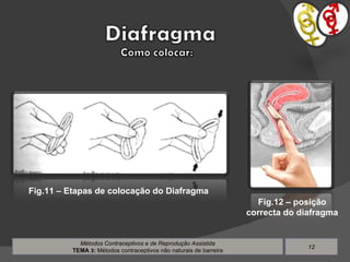 Métodos Contraceptivos e de Reprodução Assistida TEMA  3 :  Métodos contraceptivos não naturais de barreira Fig.11 – Etapas de colocação do Diafragma Fig.12 – posição correcta do diafragma 