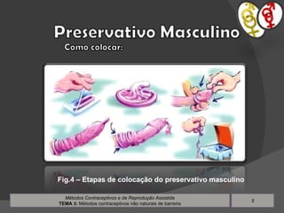Métodos Contraceptivos e de Reprodução Assistida TEMA  3 :  Métodos contraceptivos não naturais de barreira Fig.4 – Etapas de colocação do preservativo masculino 