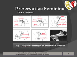 Métodos Contraceptivos e de Reprodução Assistida TEMA  3 :  Métodos contraceptivos não naturais de barreira Fig.7 – Etapas de colocação do preservativo feminino 